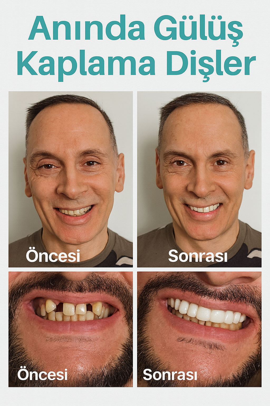 SnapSmile Pro™ – Diş Kaplama Tak Çıkar Diş Beyazlatıcı Takma Diş